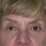 Blepharoplasty 17 After Photo - 12