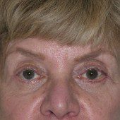 Blepharoplasty 17