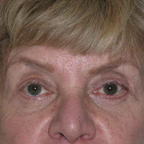 Blepharoplasty 17 After Photo 