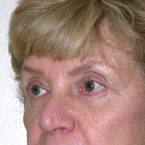 Blepharoplasty 17 After Photo