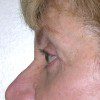 Blepharoplasty 17 After Photo Thumbnail