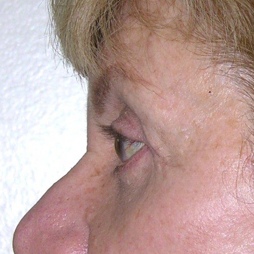 Blepharoplasty 17 After Photo