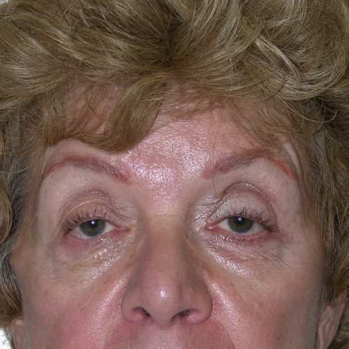 Blepharoplasty 17 Before Photo 