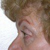 Blepharoplasty 17 Before Photo Thumbnail