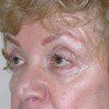 Blepharoplasty 17 Before Photo Thumbnail