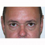 Blepharoplasty 18 After Photo - 10