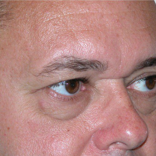 Blepharoplasty 18 After Photo