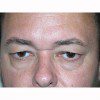 Blepharoplasty 18 Before Photo Thumbnail