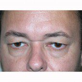Blepharoplasty 18
