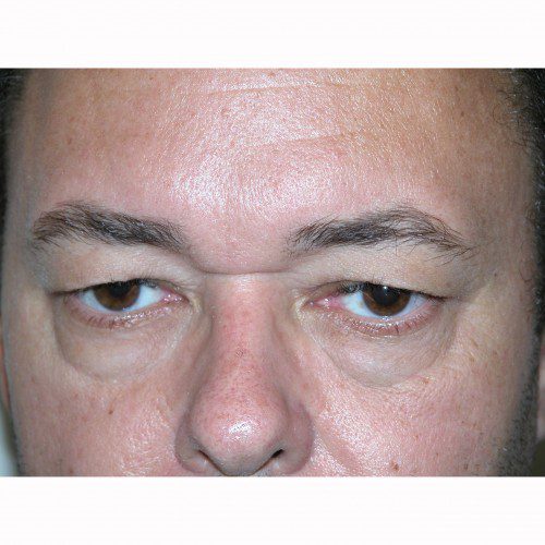 Blepharoplasty 18 Before Photo 