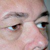 Blepharoplasty 18 Before Photo Thumbnail