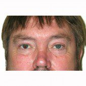 Blepharoplasty 19