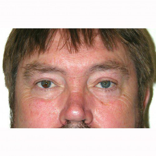 Blepharoplasty 19 After Photo 