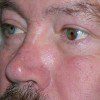 Blepharoplasty 19 After Photo Thumbnail