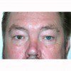 Blepharoplasty 19 Before Photo Thumbnail