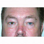 Blepharoplasty 19 Before Photo - 9