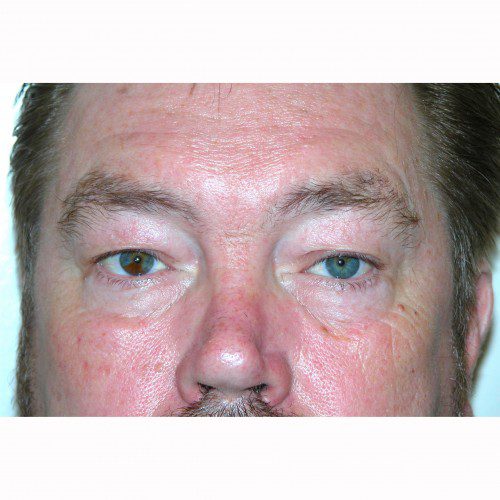 Blepharoplasty 19 Before Photo 