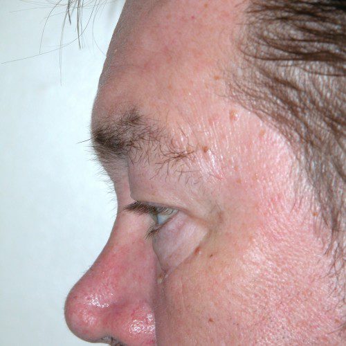 Blepharoplasty 19 Before Photo