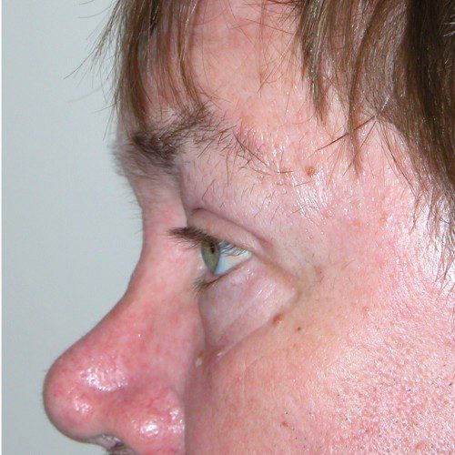 Blepharoplasty 19 After Photo