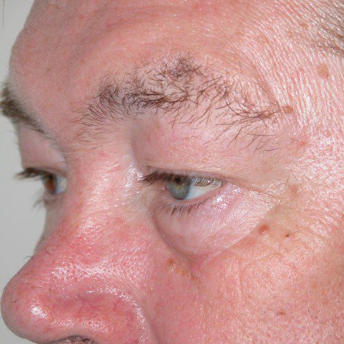 Blepharoplasty 19 Before Photo