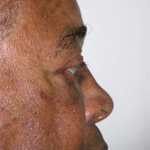 Blepharoplasty 20 After Photo