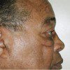 Blepharoplasty 20 Before Photo Thumbnail