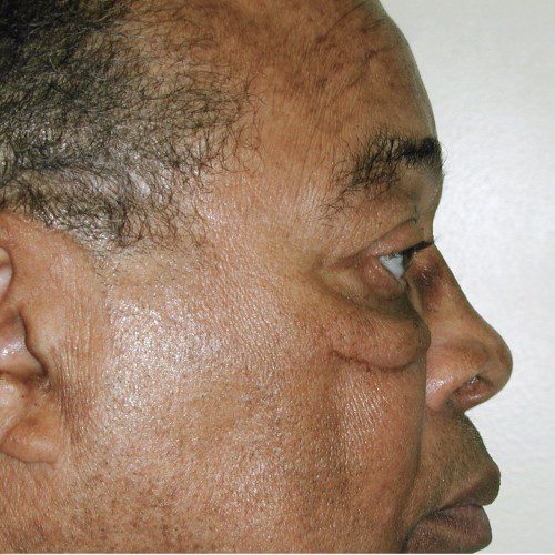 Blepharoplasty 20 Before Photo