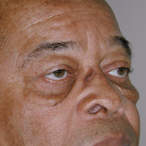 Blepharoplasty 20 Before Photo