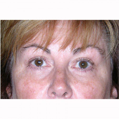 Blepharoplasty 3 After Photo 