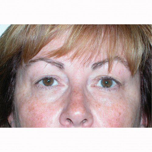 Blepharoplasty 3 Before Photo 