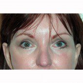 Blepharoplasty 21