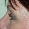 Blepharoplasty 21 After Photo Thumbnail