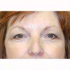 Blepharoplasty 21 Before Photo Thumbnail