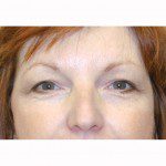 Blepharoplasty 21 Before Photo - 8