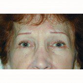 Blepharoplasty 4