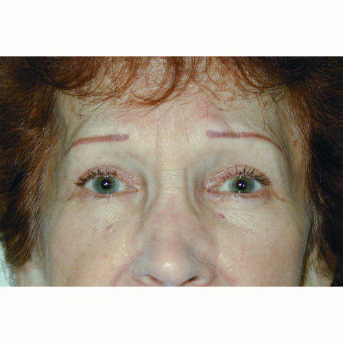 Blepharoplasty 4 After Photo 