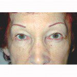 Blepharoplasty 4 Before Photo - 12