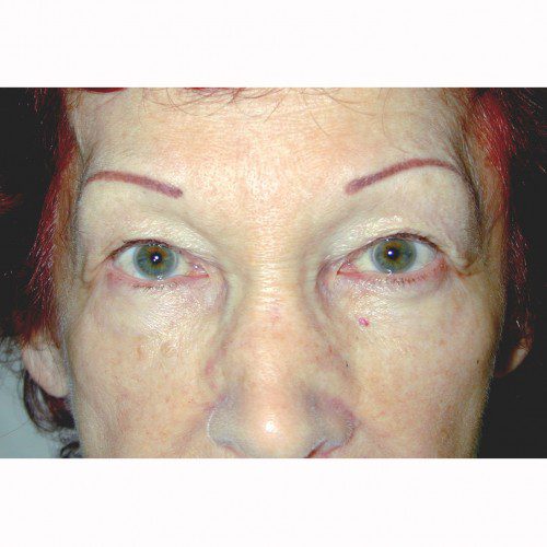 Blepharoplasty 4 Before Photo 