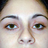 Blepharoplasty 6