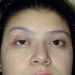 Blepharoplasty 6 Before Photo - 10