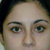 Blepharoplasty 7 After Photo Thumbnail