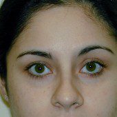 Blepharoplasty 7