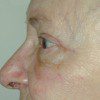 Blepharoplasty 8 After Photo Thumbnail