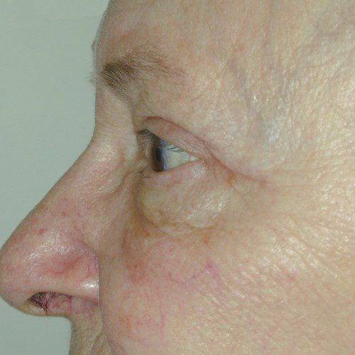 Blepharoplasty 8 After Photo