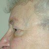 Blepharoplasty 8 Before Photo Thumbnail