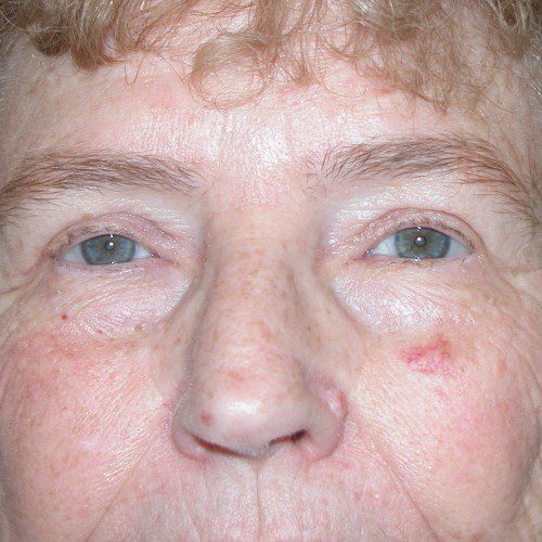 Blepharoplasty 9 After Photo 