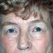 Blepharoplasty 9