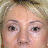 Blepharoplasty 10