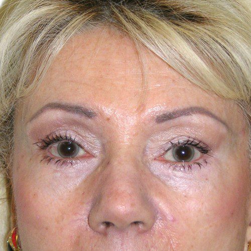 Blepharoplasty 10 After Photo 