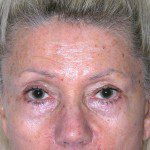 Blepharoplasty 10 Before Photo - 6